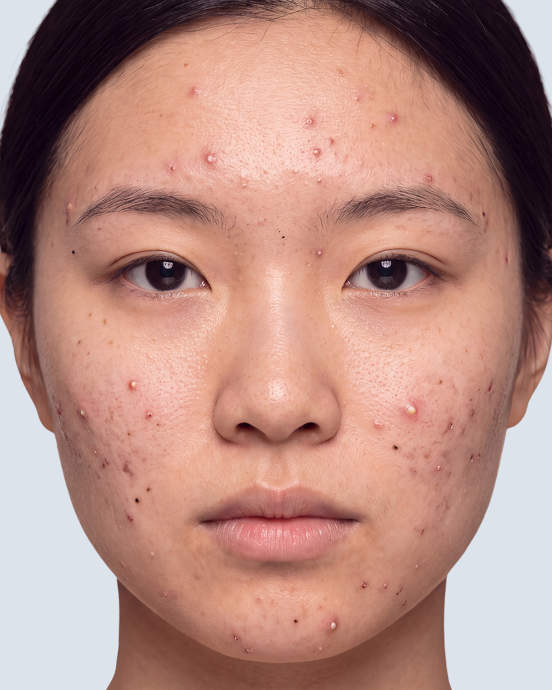 Barrier-Restoring Acne Ritual