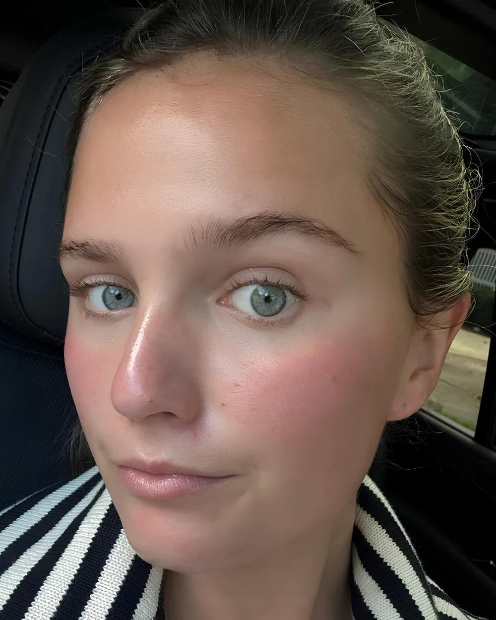 Skin At Peace skin transformation 2 — before
