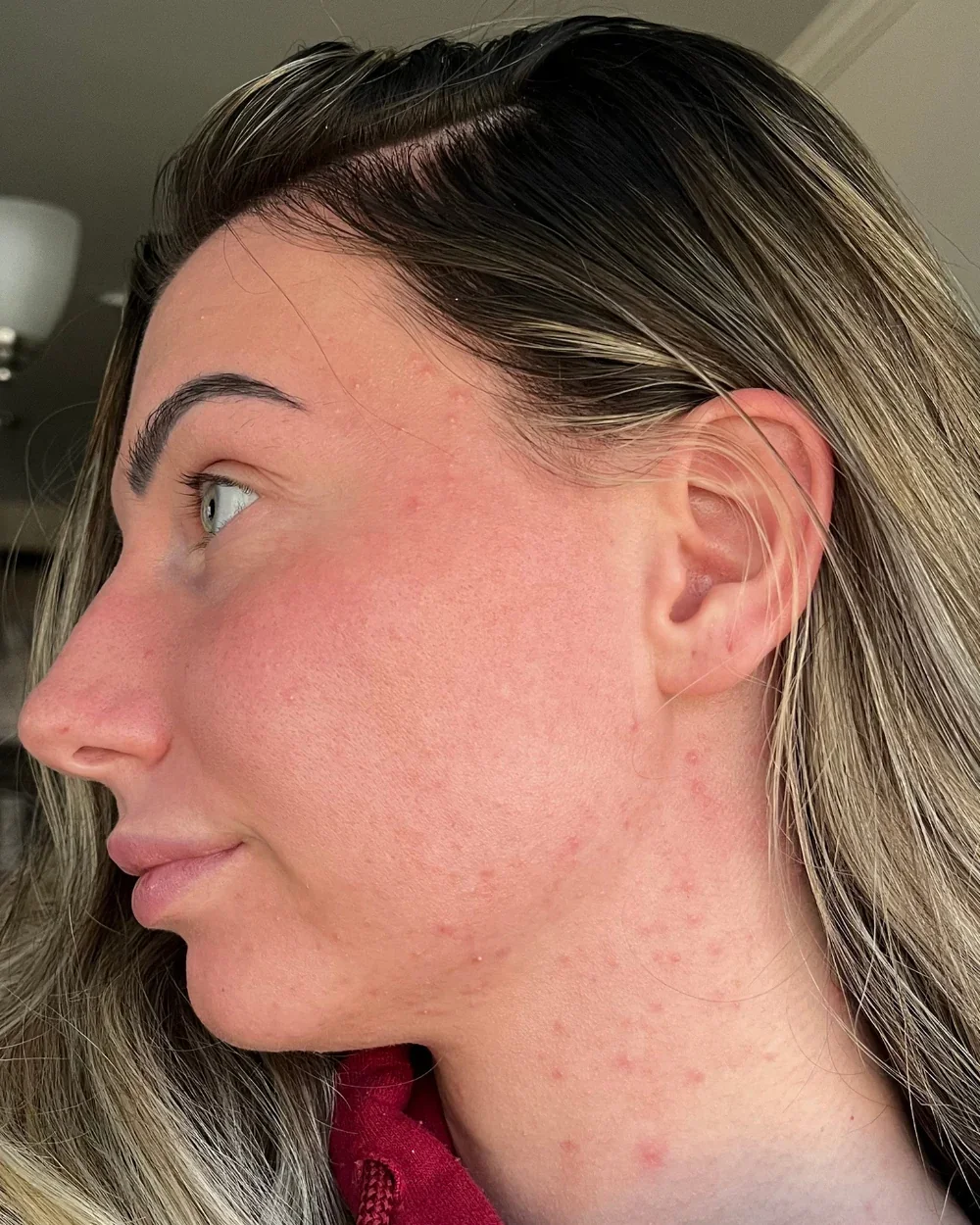Skin At Peace skin transformation 4 — before